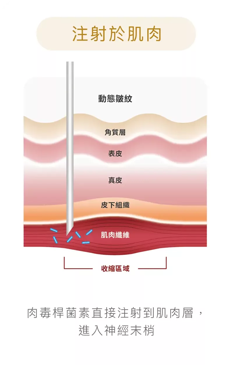 淨優明天使肉毒 XEOMIN 2 肉毒桿菌注射肌肉層示意圖