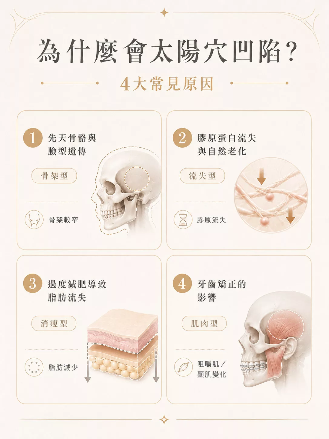 太陽穴凹陷怎麼辦?夫妻宮填補與醫美療程選擇指南 2 太陽穴凹陷四大原因:骨骼、膠原蛋白流失、減肥、牙齒影響
