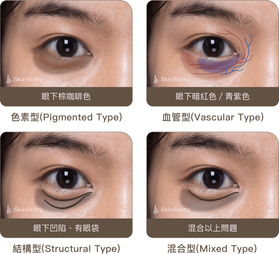 四種黑眼圈的類型，分別是色素型、血管型、結構型、混和型。