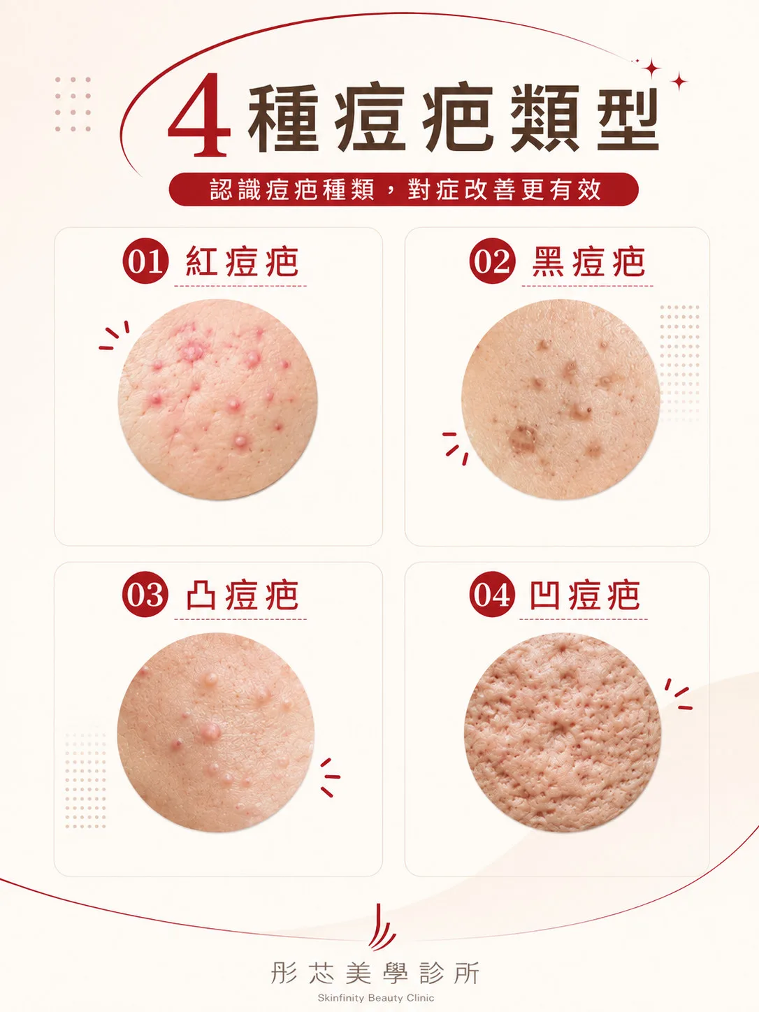 痘疤治療怎麼選?凹痘疤類型、療程比較與複合式治療完整解析 1 四種痘疤類型:紅痘疤、黑痘疤、凸痘疤、凹痘疤