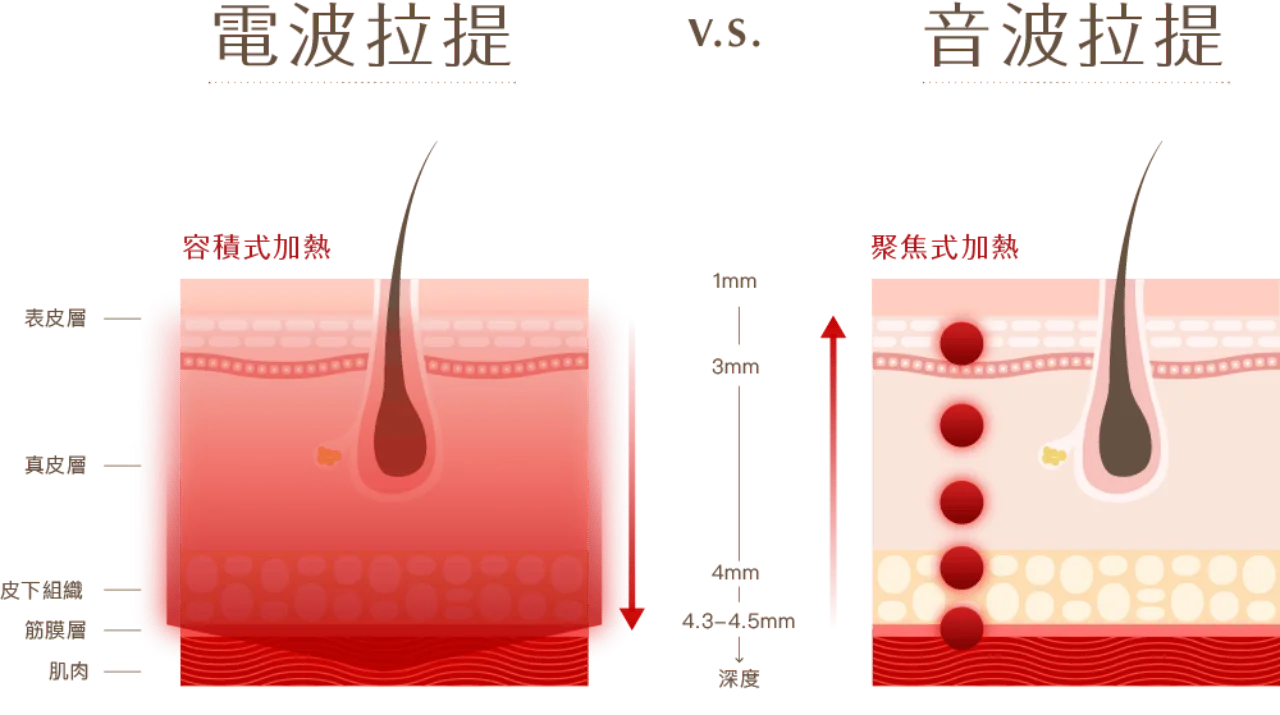 美國音波鳳凰電波怎麼選?差別全解析,價格與效果大公開 3 電波拉提與音波拉提的不同