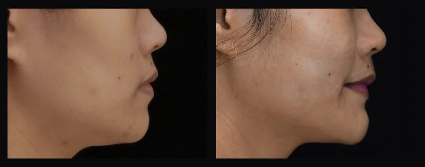 玻尿酸 | 澎潤你的蘋果肌、凹頰 2 並排比較一個人的臉部,顯示側面視圖,左圖顯示顯示尚未經過玻尿酸填充蘋果肌的樣貌;右圖顯示了同一張臉經過蘋果肌填充的樣貌。