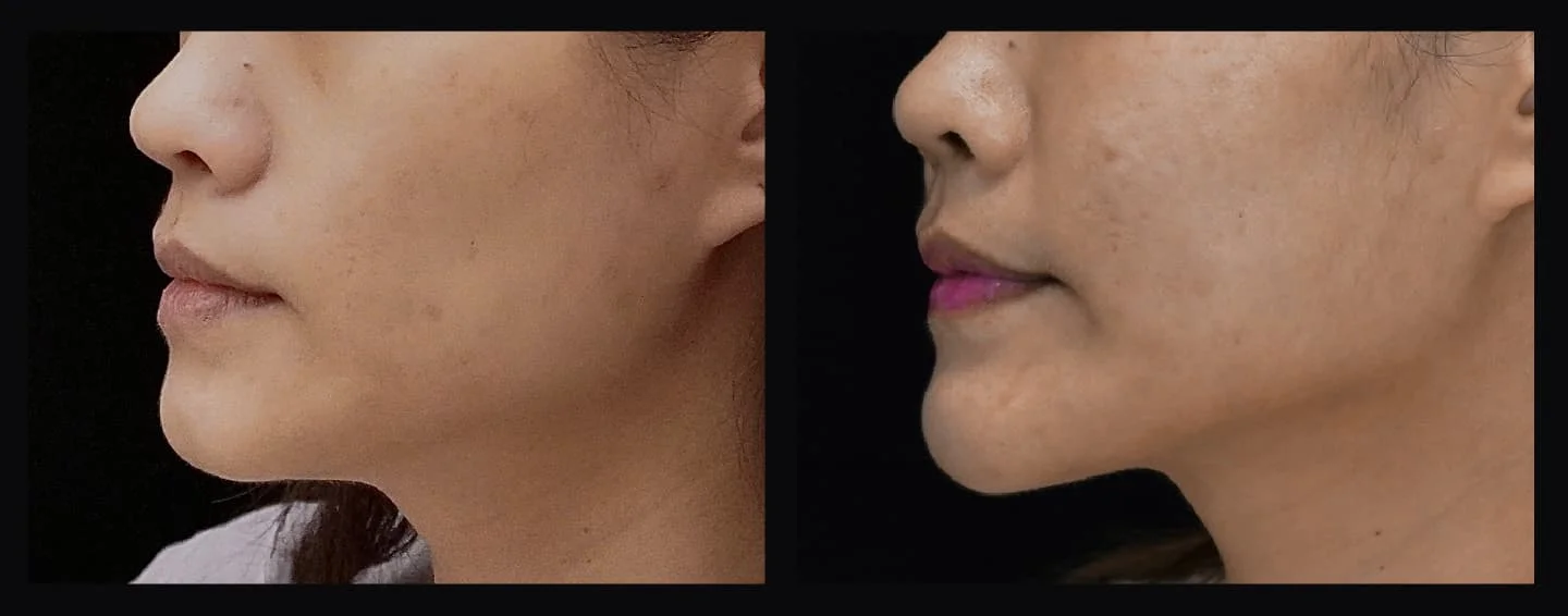 玻尿酸 | 澎潤你的蘋果肌、凹頰 4 女性臉部的並排前後照片,重點是下巴線和臉頰區域,左圖顯示逼尿酸治療前的臉部,右圖突出顯示蘋果肌的改善,嘴唇上有明顯的化妝。