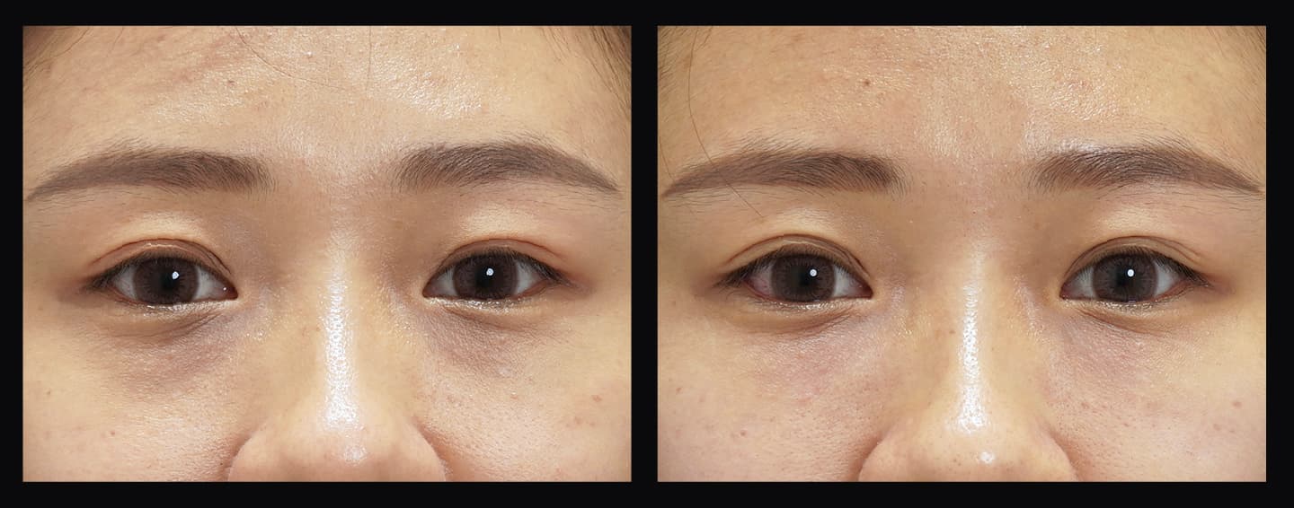 女性眼部照片的黑眼圈消除狀況對比，展現眼周肌膚與膠原蛋白改善效果。