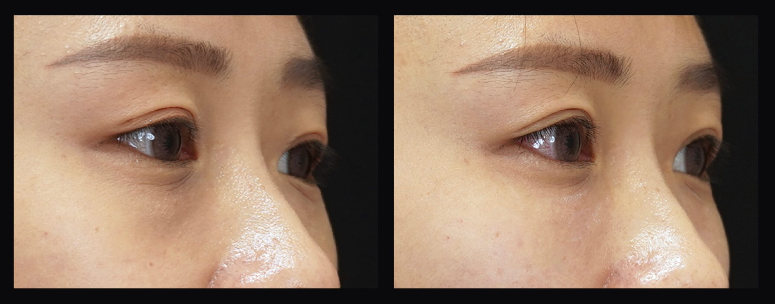 一位女性黑眼圈改善後的眼睛恢復活力，皮膚較光滑，淚溝減少。