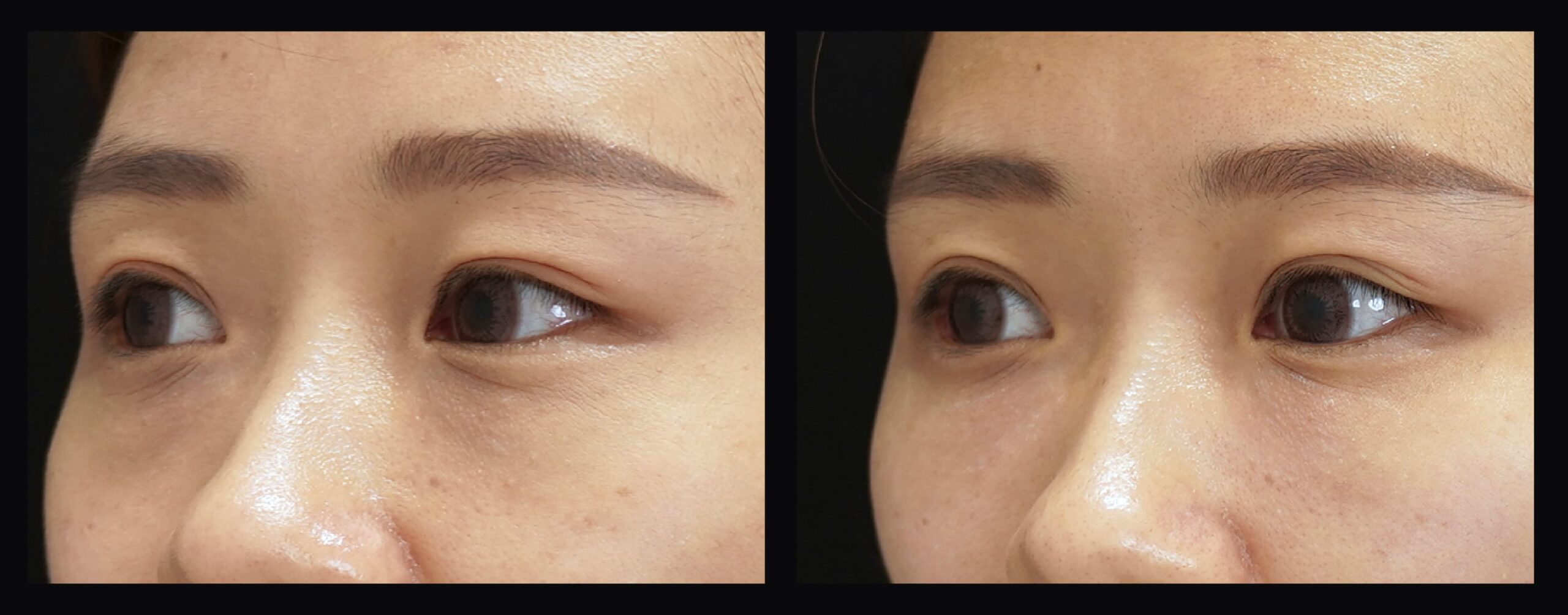 女性利用膠原蛋白在眼瞼淚溝導致眼周皮膚更緊的改變。